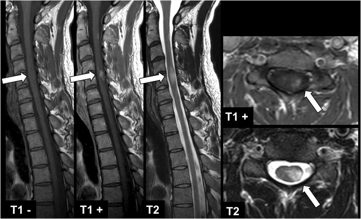 Pre-contrast T1-weighted imaging of the spinal cord may be unnecessary in  patients with multiple sclerosis | European Radiology