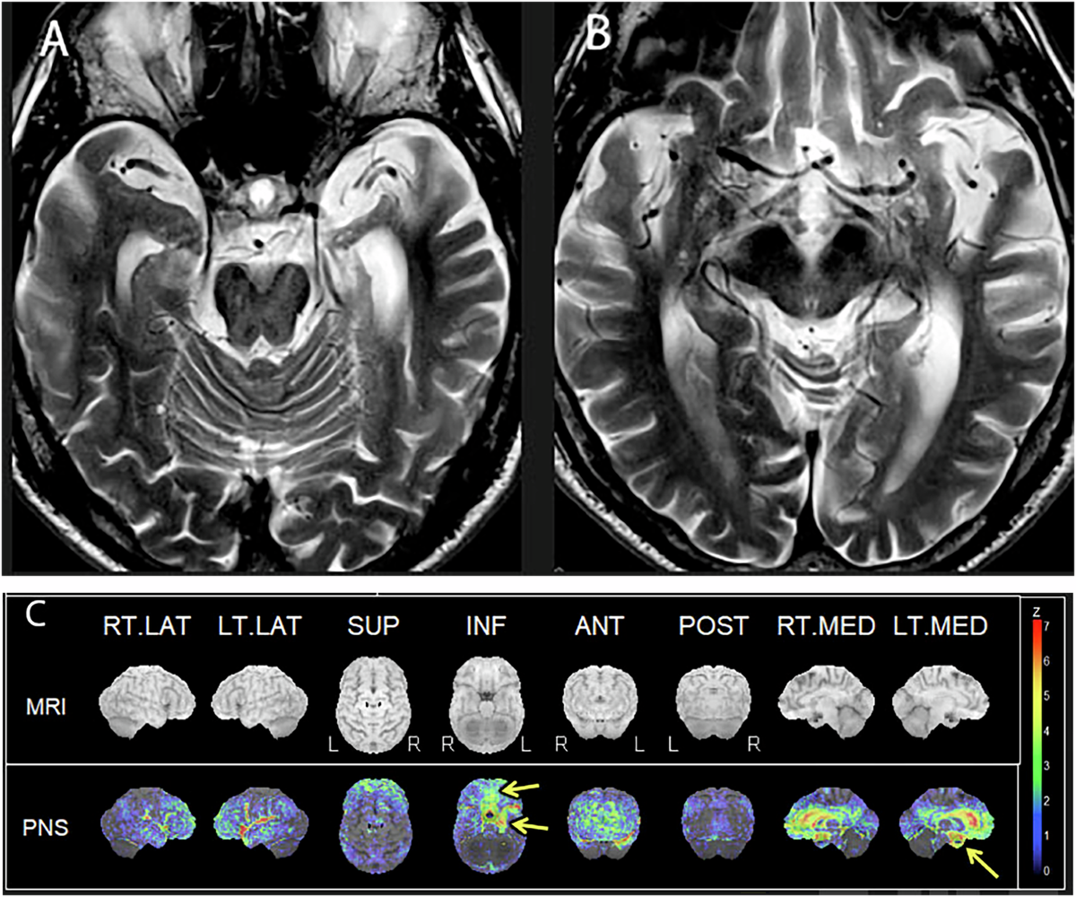 The role of brain MR and FDG-PET in the diagnosis of neurodegenerative  disease | European Radiology | Springer Nature Link