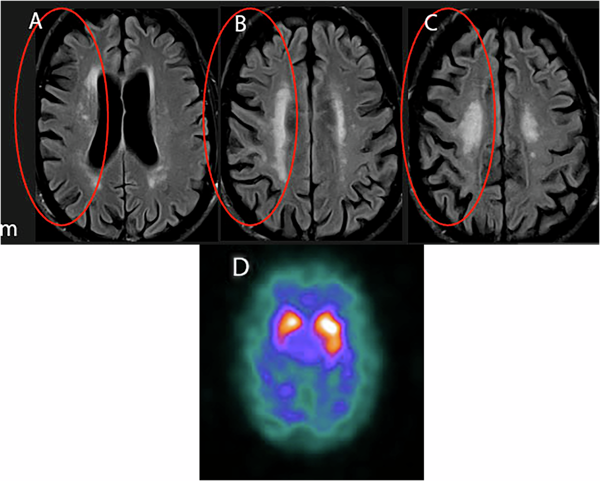 The role of brain MR and FDG-PET in the diagnosis of neurodegenerative  disease | European Radiology | Springer Nature Link