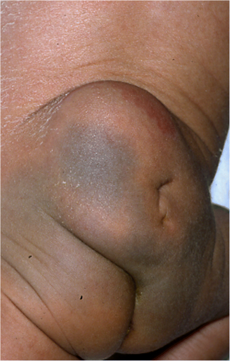 mongoloid girl nude A comprehensive review of Mongolian spots with an update on atypical  presentations | Child's Nervous System