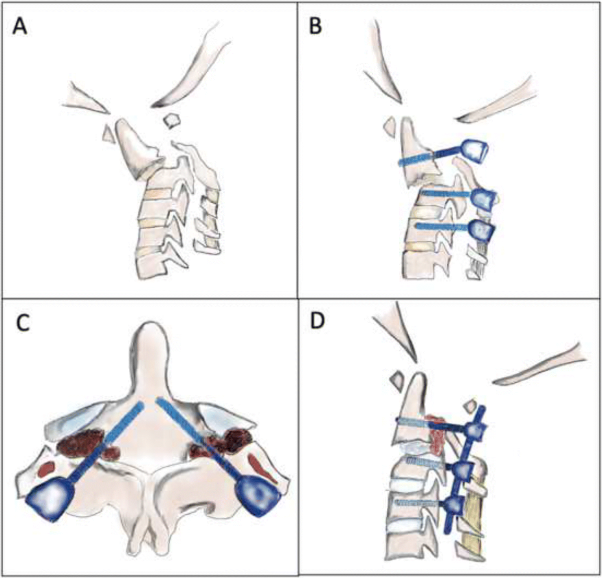 Posterior fixation for paediatric and adolescent unstable hangman's fracture:  evolution to C1 sparing techniques | Child's Nervous System, image size:1200x1152