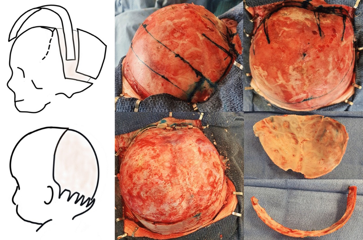 الجراحة المفتوحة (Open Cranial Vault Reconstruction)