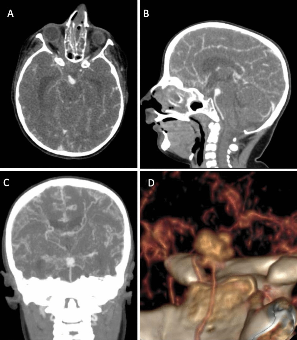 Central nervous system vasculopathy and Seckel syndrome: case illustration  and systematic review | Child's Nervous System, image size:1200x1373