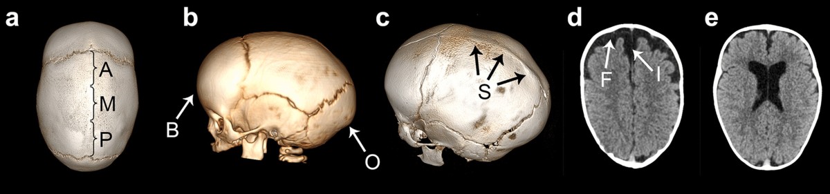 Radiomorphologic profiles of nonsyndromic sagittal ...