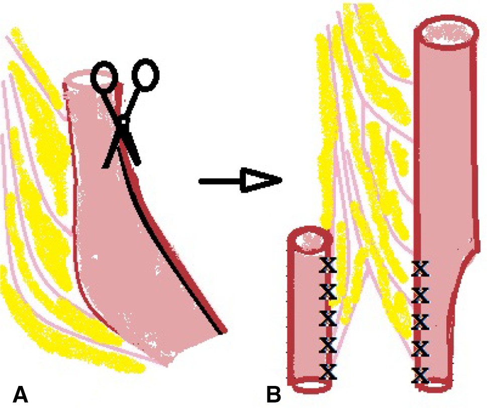 Early vaginal replacement in cloacal malformation | Pediatric Surgery  International