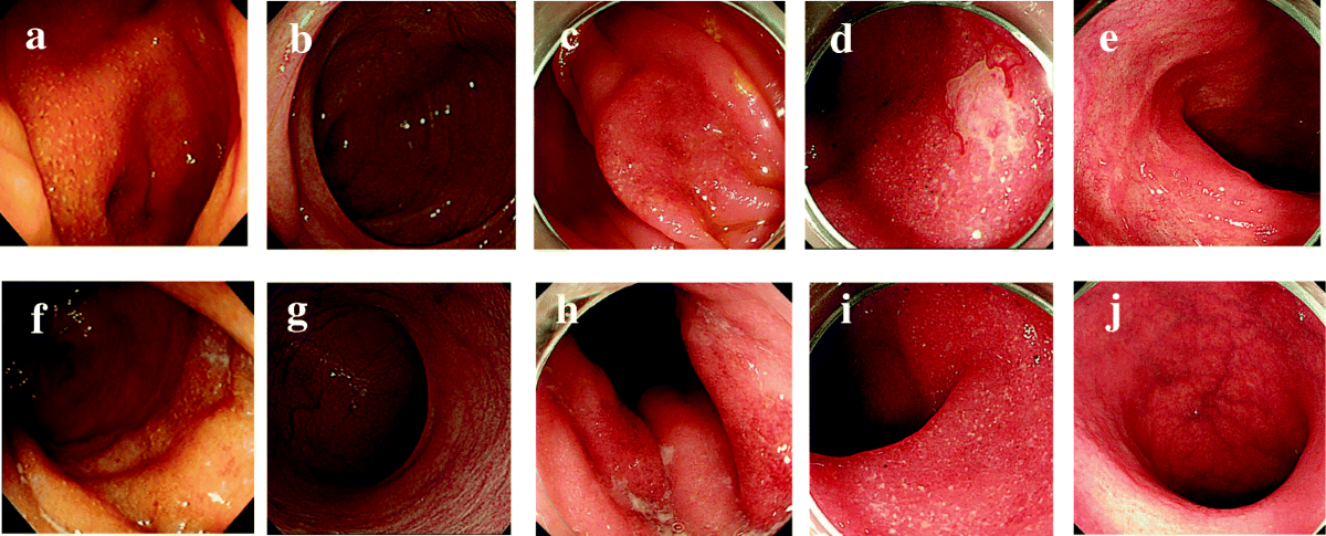 Remission of ulcerative colitis flare-up induced by nivolumab | International Journal of Colorectal Disease | Springer Nature Link Remission of ulcerative colitis flare-up induced by nivolumab | International Journal of Colorectal Disease | Springer Nature Link