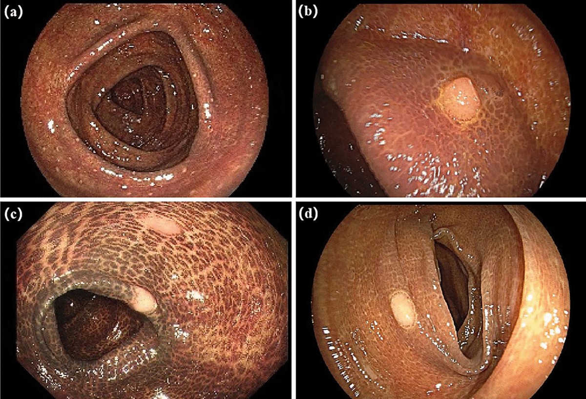 melanotic stool Melanosis coli: a contrast effect or an oncogenic effect? A large-scale  retrospective cohort study | International Journal of Colorectal Disease