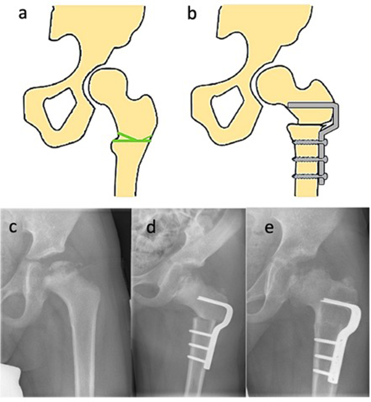 Legg-Calvé-Perthes disease– surgical treatment options | Archives of  Orthopaedic and Trauma Surgery, image size:1200x1300