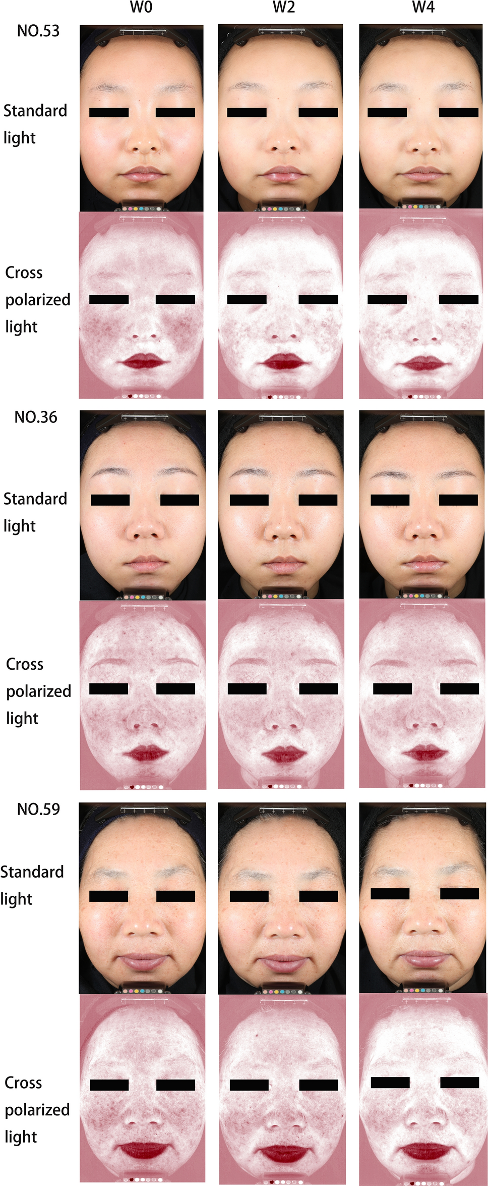Clinical study of a spray containing birch juice for repairing sensitive  skin | Archives of Dermatological Research