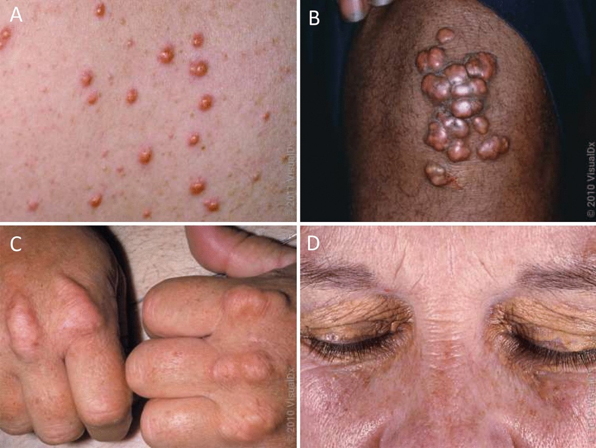 Is this xanthelasma? : r/Cholesterol, image size:1200x902