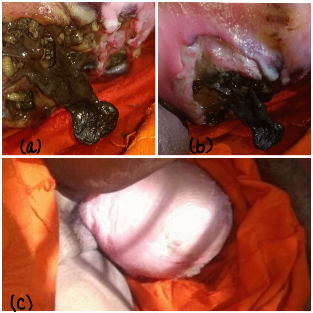 Maggots in genital prolapse | Archives of Gynecology and Obstetrics