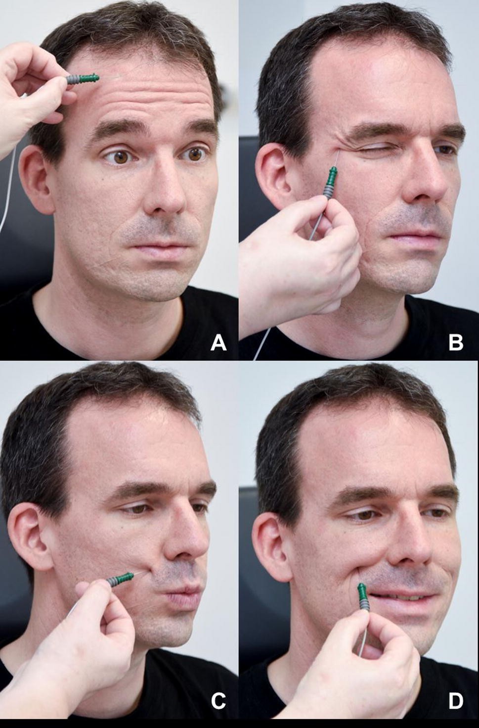 Facial nerve electrodiagnostics for patients with facial palsy: a clinical  practice guideline | European Archives of Oto-Rhino-Laryngology, image size:969x1471