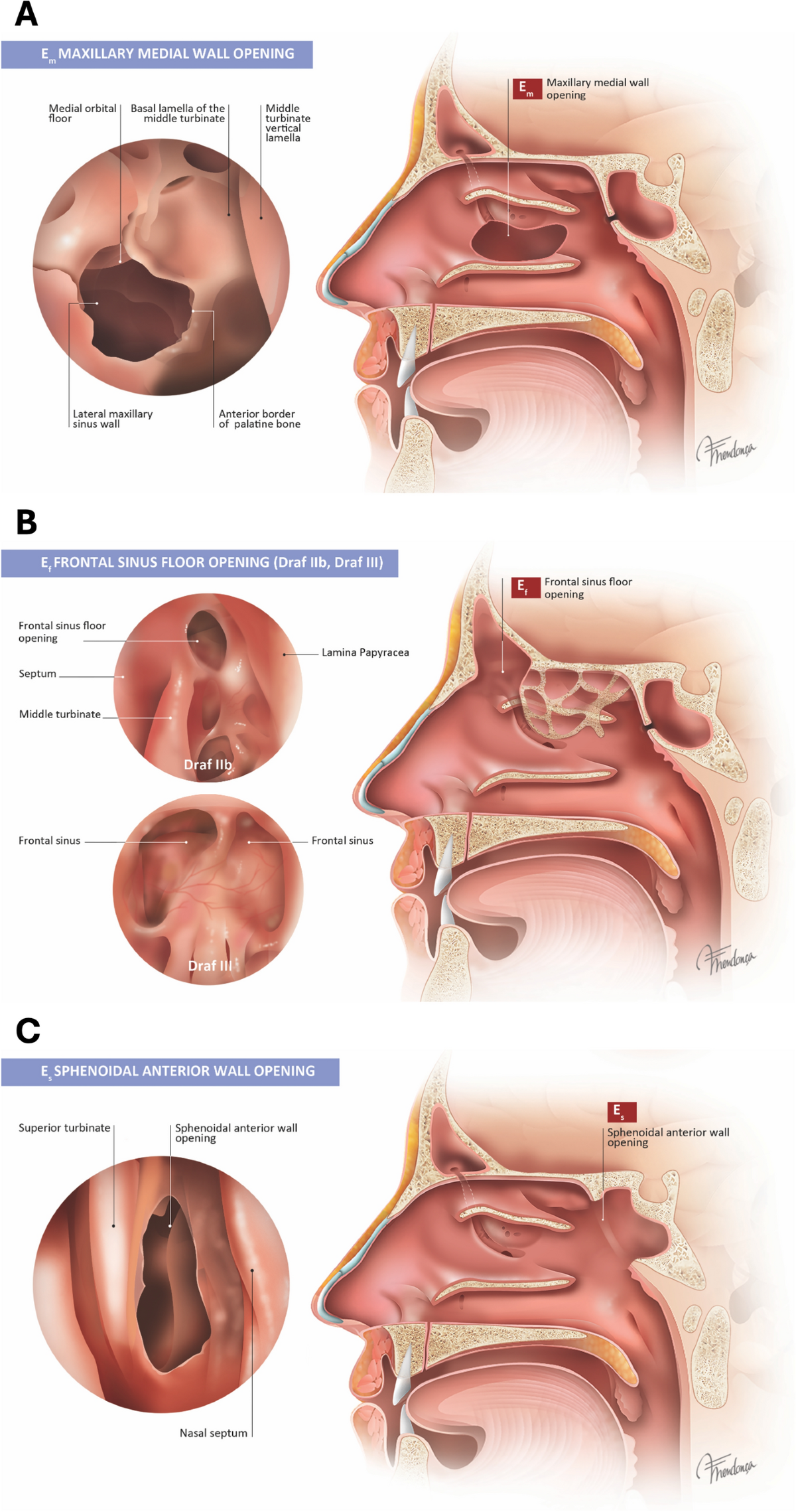 The Lamella Ostium Extent Mucosa (LOEM) system: a new classification and  pilot study for endoscopic sinus surgery | European Archives of  Oto-Rhino-Laryngology | Springer Nature Link