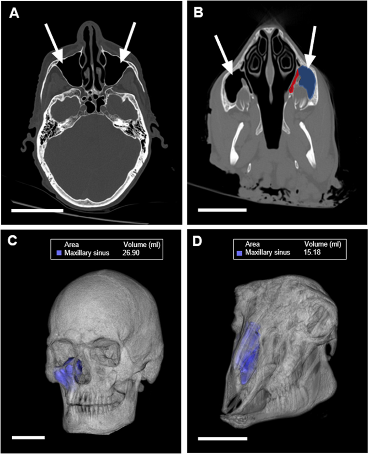 Postmortem CT analysis of paranasal sinuses using an experimental model of  drowning | International Journal of Legal Medicine, image size:1200x1479