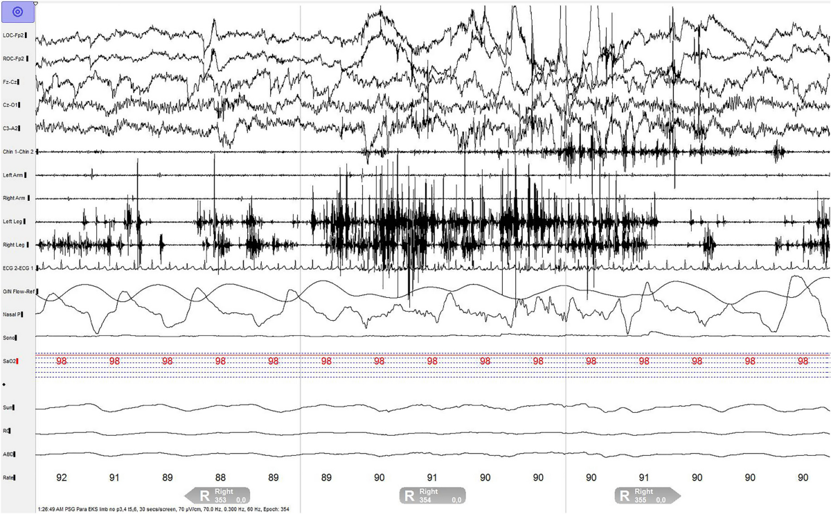 Sleep disturbances associated with DPPX autoantibodies: a case series |  Journal of Neurology