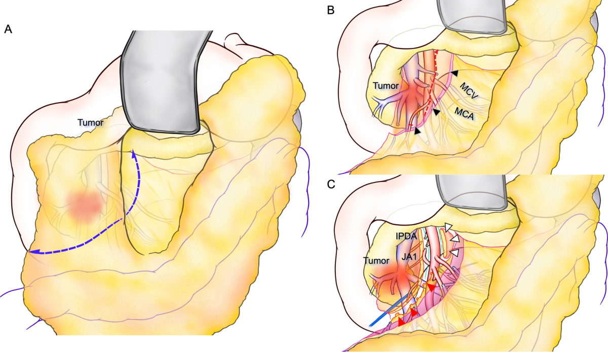 Superior Mesenteric Artery Plexus-Preserving Pancreatoduodenectomy with  Circumferential Dissection of Lymph Nodes - Journal of Gastrointestinal  Surgery, image size:1200x696