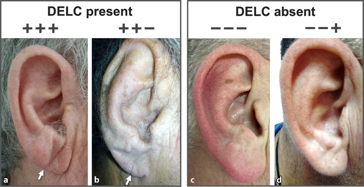 The relationship of diagonal earlobe crease (Frank's sign) and obstructive coronary artery disease in patients undergoing coronary angiography | Wiener klinische Wochenschrift