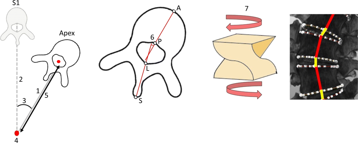 CT-based study of vertebral and intravertebral rotation in right thoracic adolescent idiopathic scoliosis | European Spine Journal