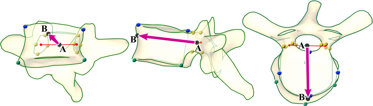 Axial plane characteristics of thoracic scoliosis and their usefulness for  determining the fusion levels and the correction technique | European Spine  Journal