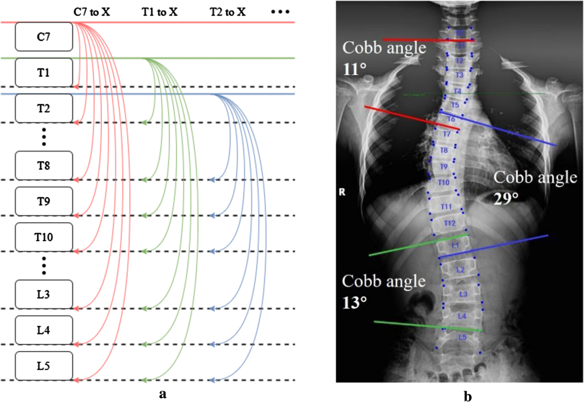 Comparison of manual versus automated measurement of Cobb angle in  idiopathic scoliosis based on a deep learning keypoint detection technology  | European Spine Journal