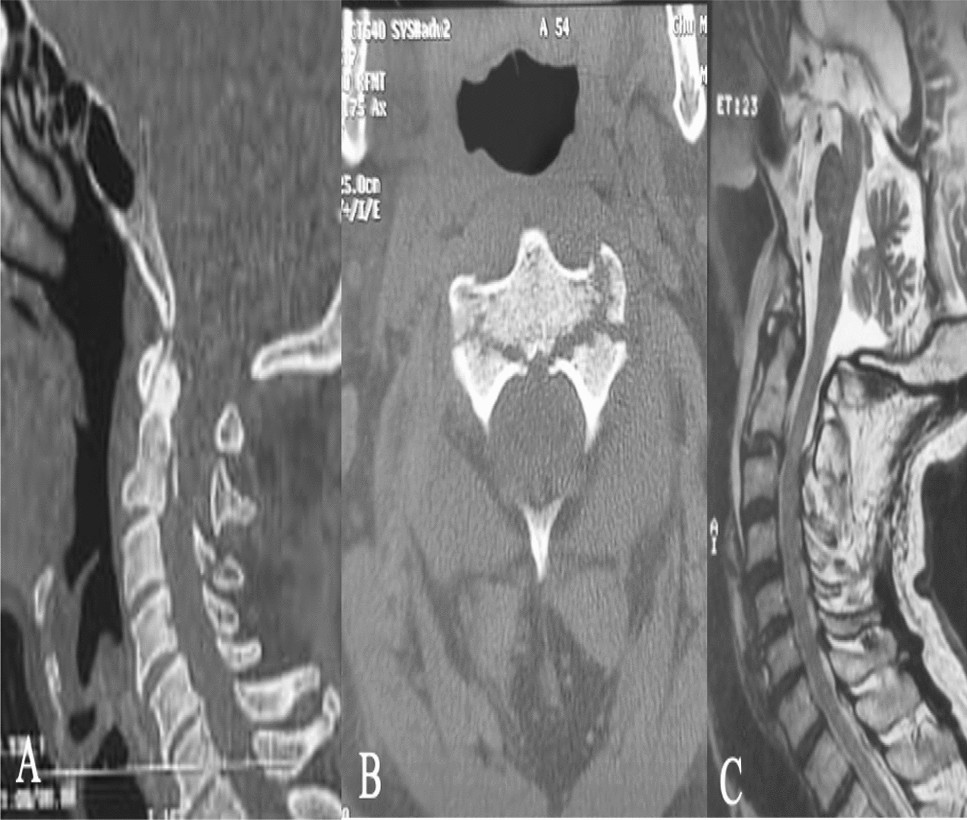 Traumatic atlantoaxial dislocation with Hangman fracture - The Spine Journal, image size:967x820