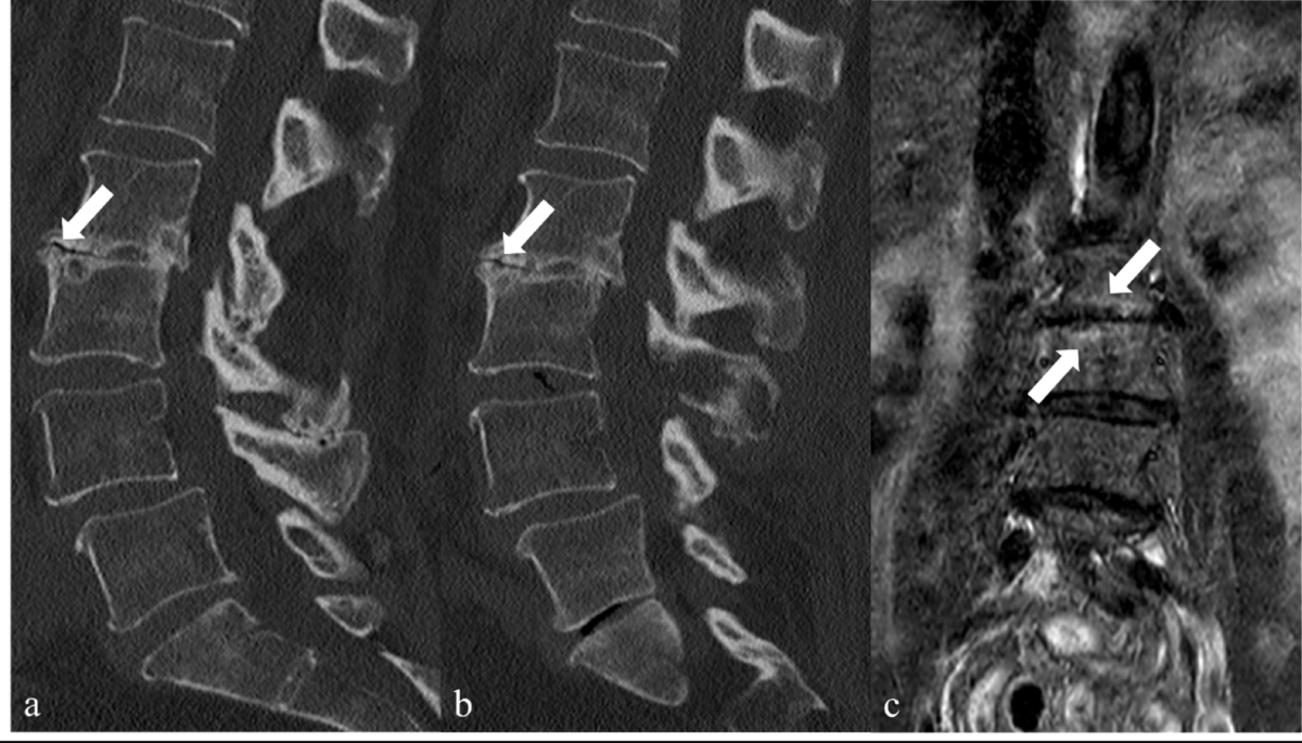 What is the Treatment for Vacuum Disc Phenomenon: Effective Solutions Revealed