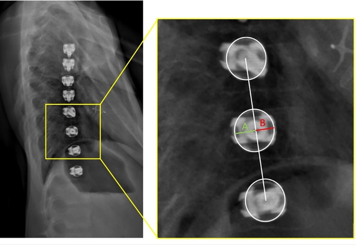 Does screw alignment affect tether breakage in vertebral body tethering? |  European Spine Journal | Springer Nature Link