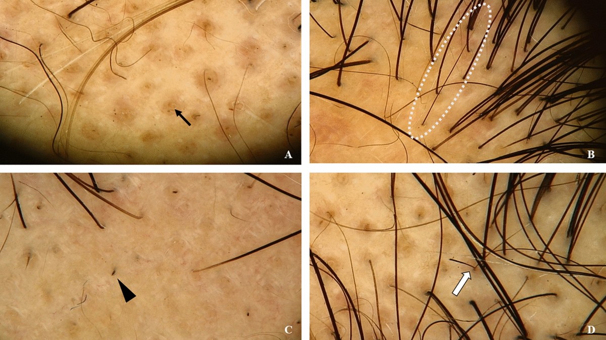 glutathione and alopecia areata Injections For Androgenic (Male Pattern Baldness) | Dr. JJ, Naturopathic Doctor Dissecting hair breakage in alopecia