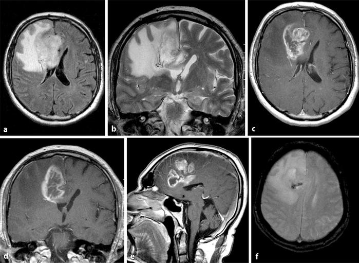 Diagnostik und Therapie des Glioblastoms | Die Onkologie
