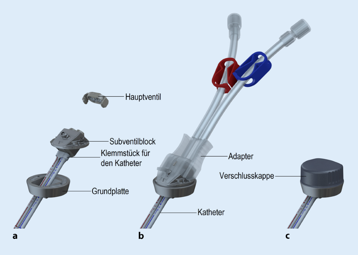 Retroaurikulär fixierter Port zur Hämodialyse: erste klinische Erfahrung |  Gefässchirurgie, image size:1200x857