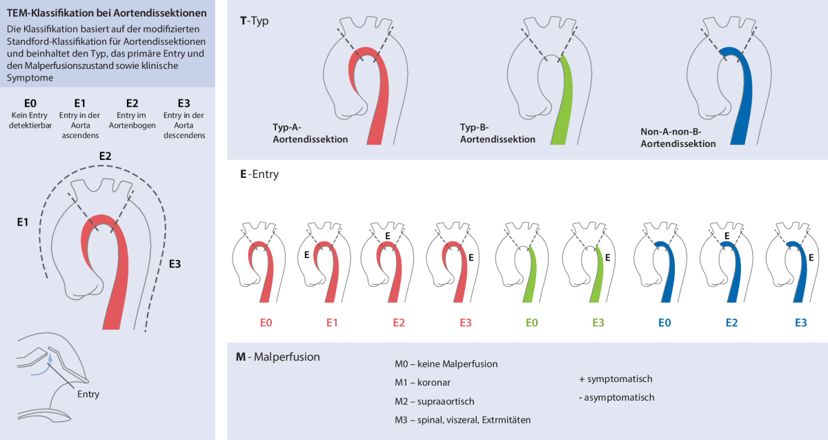 Die Bedeutung des Aortenbogenersatzes in Frozen-Elephant-Trunk-Technik bei  akuten Aortendissektionen | Gefsschirurgie | Springer Nature Link