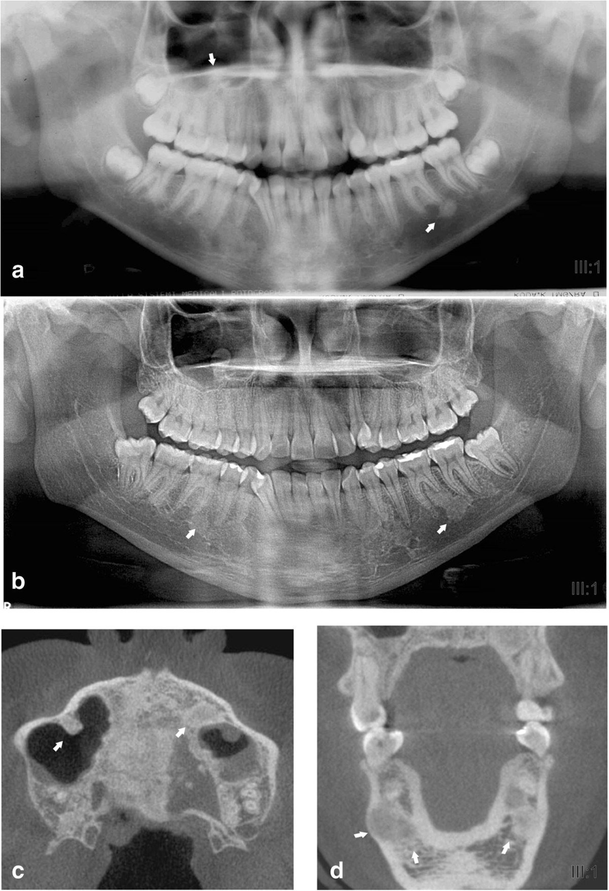 Dento-osseous anomalies in patients with familial adenomatous polyposis: A  follow-up study | Clinical Oral Investigations, image size:1200x1756