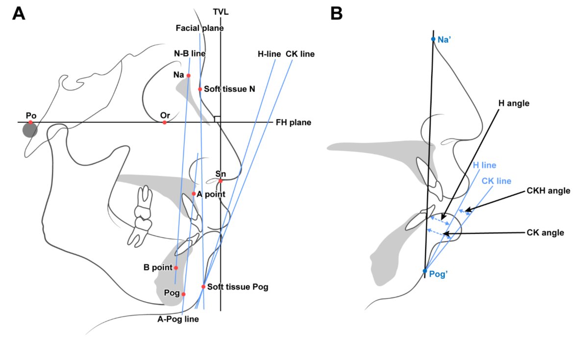 Soft tissue paradigm based Treatment planning in skeletal class III |  Clinical Oral Investigations | Springer Nature Link