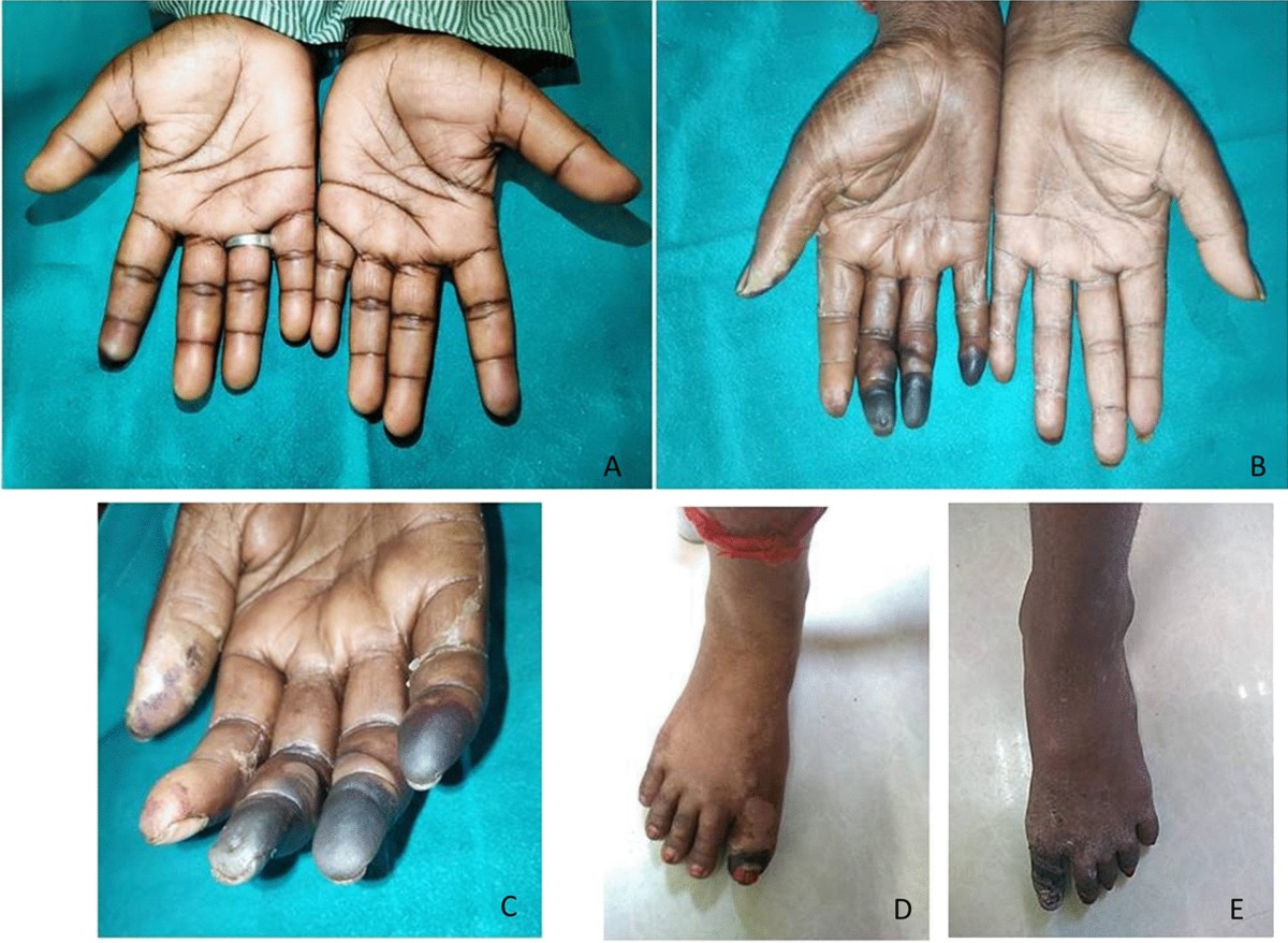 Renal Foot in Diabetes: Implications for Wound Healing and Solutions |  Advances in Wound Care, image size:1200x878