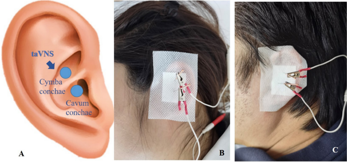 acetyl l carnitine for vagus nerve Efficacy of transauricular vagus nerve stimulation for the treatment of  chemotherapy-induced painful peripheral neuropathy: a randomized controlled  exploratory study | Neurological Sciences