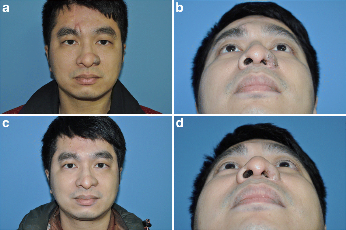 paramedian forehead flap before and after