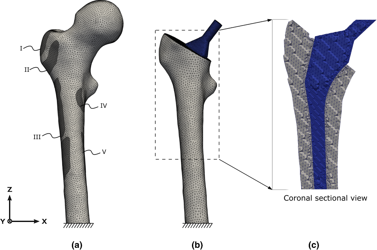 Orthotropic bone remodelling around uncemented femoral implant: a  comparison with isotropic formulation | Biomechanics and Modeling in  Mechanobiology