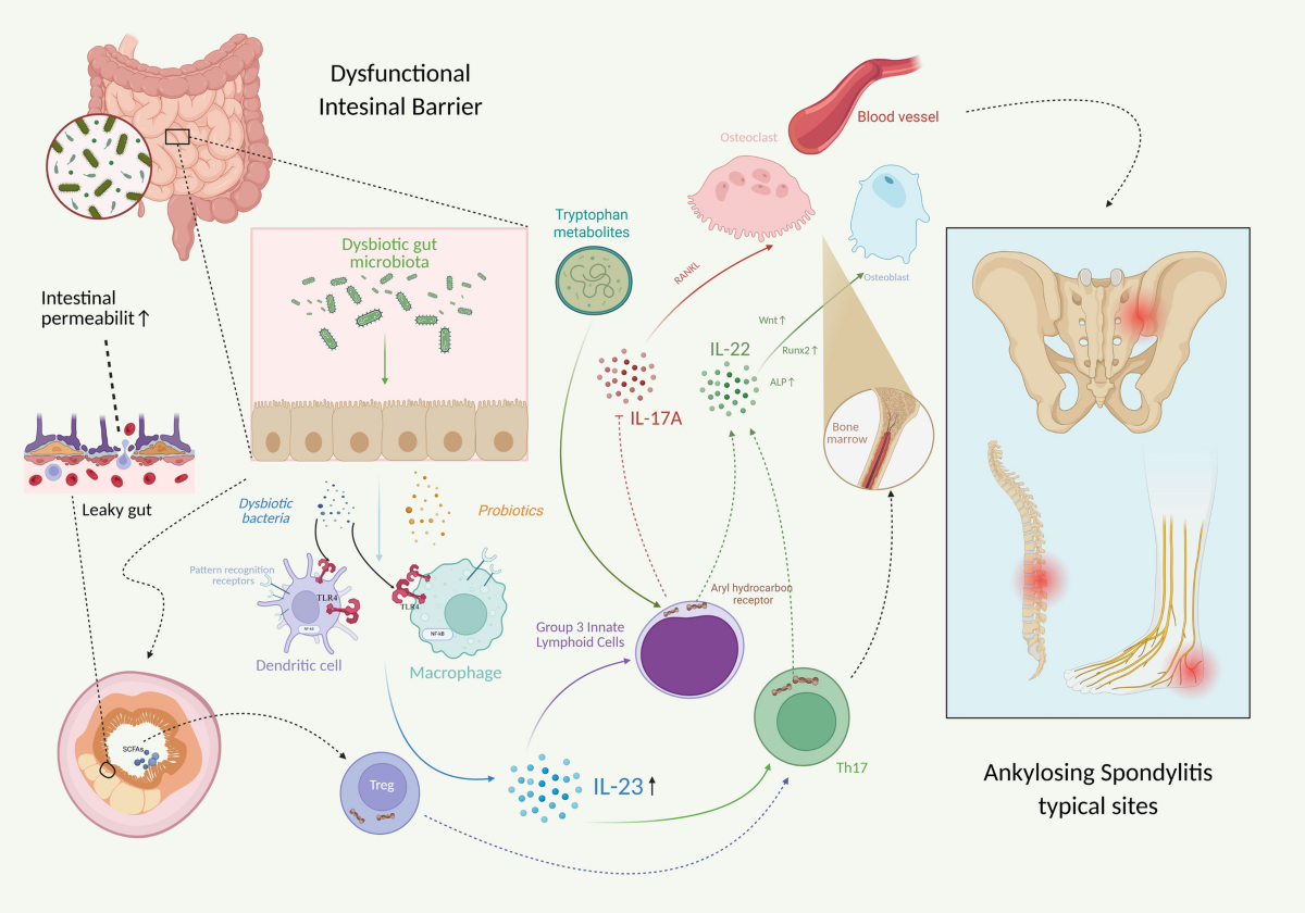 glutathione and ankylosing spondylitis 16 Effects of on the Body Ankylosing Spondylitis (AS) Singapore -