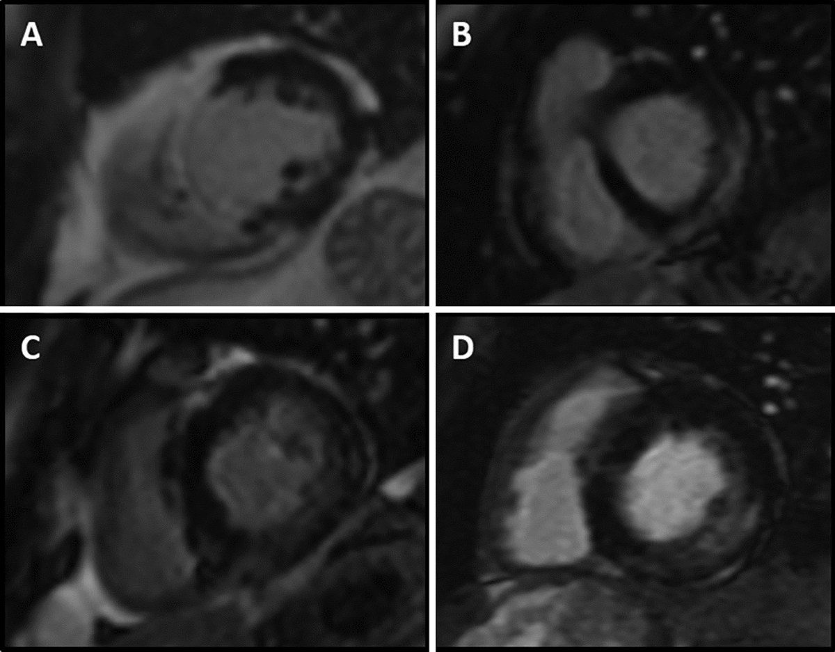 Late/delayed gadolinium enhancement in MRI after intravenous administration  of extracellular gadolinium-based contrast agents: is it worth waiting? |  Magnetic Resonance Materials in Physics, Biology and Medicine