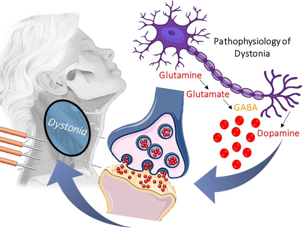 glutathione and dystonia Dystonia: pathophysiology and the role of acupuncture in treatment | Wiener  Medizinische Wochenschrift