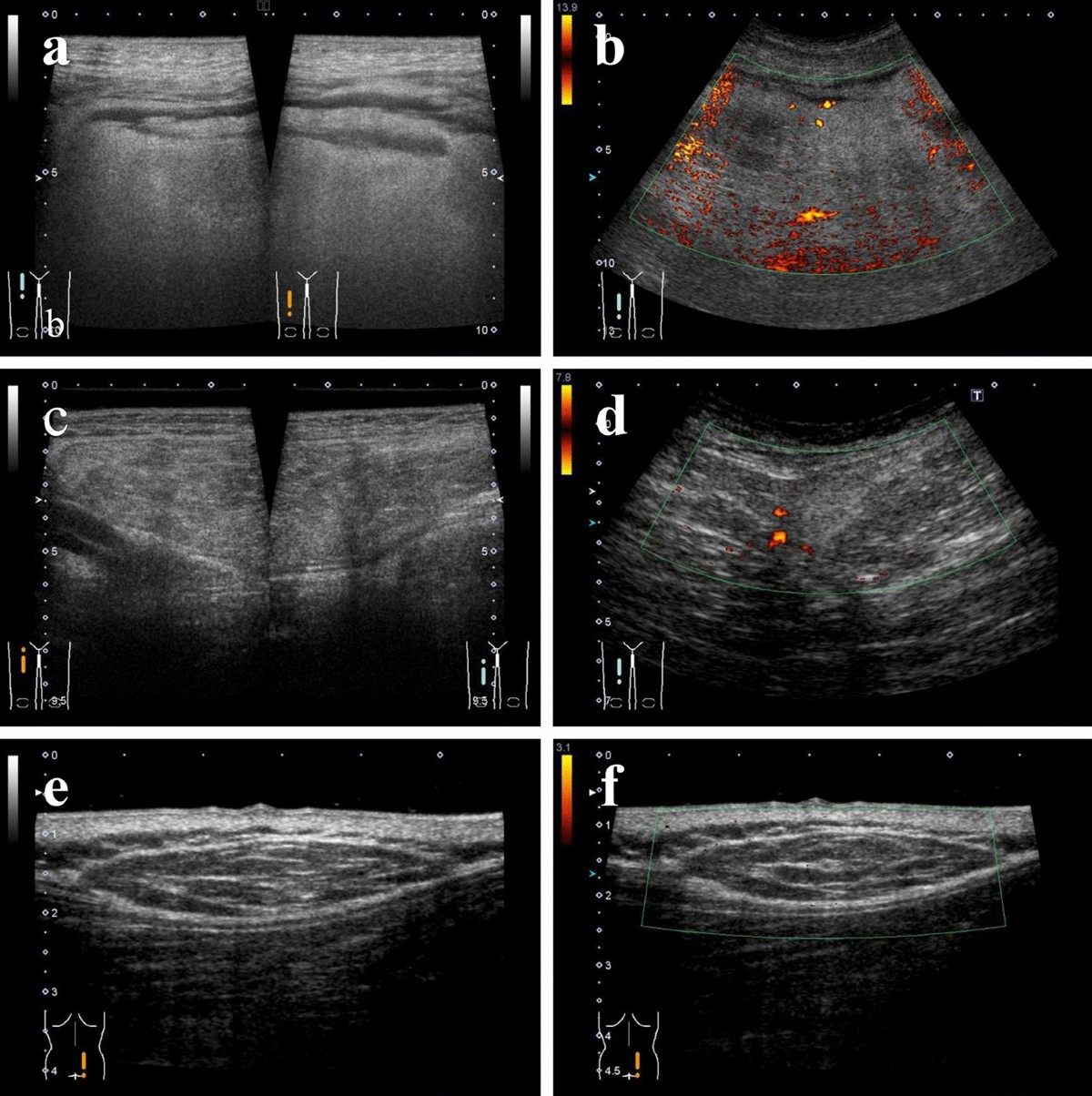Liposarcoma subtypes USG comparison - B-mode and Doppler panels