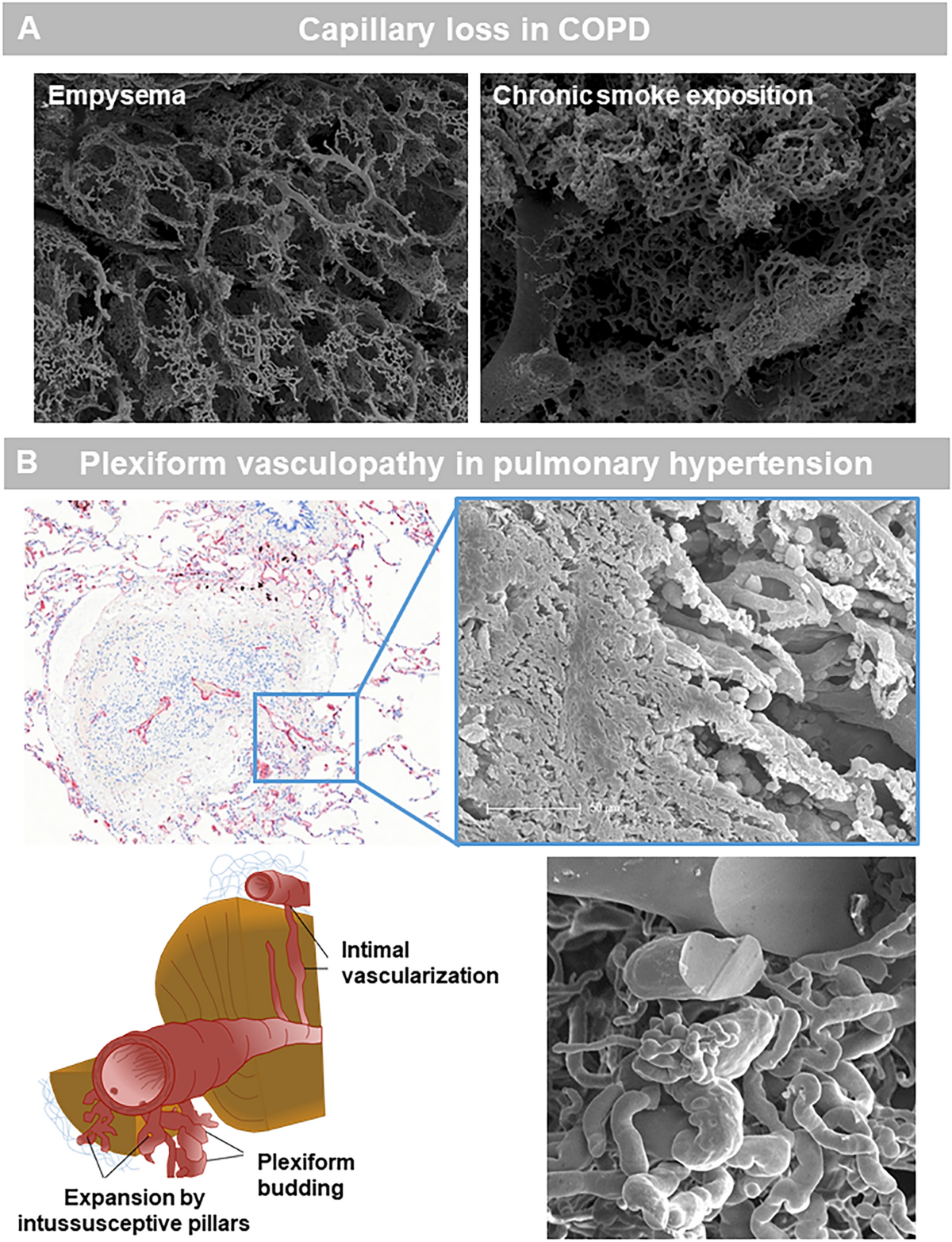 The role of vasculature and angiogenesis in respiratory diseases |  Angiogenesis