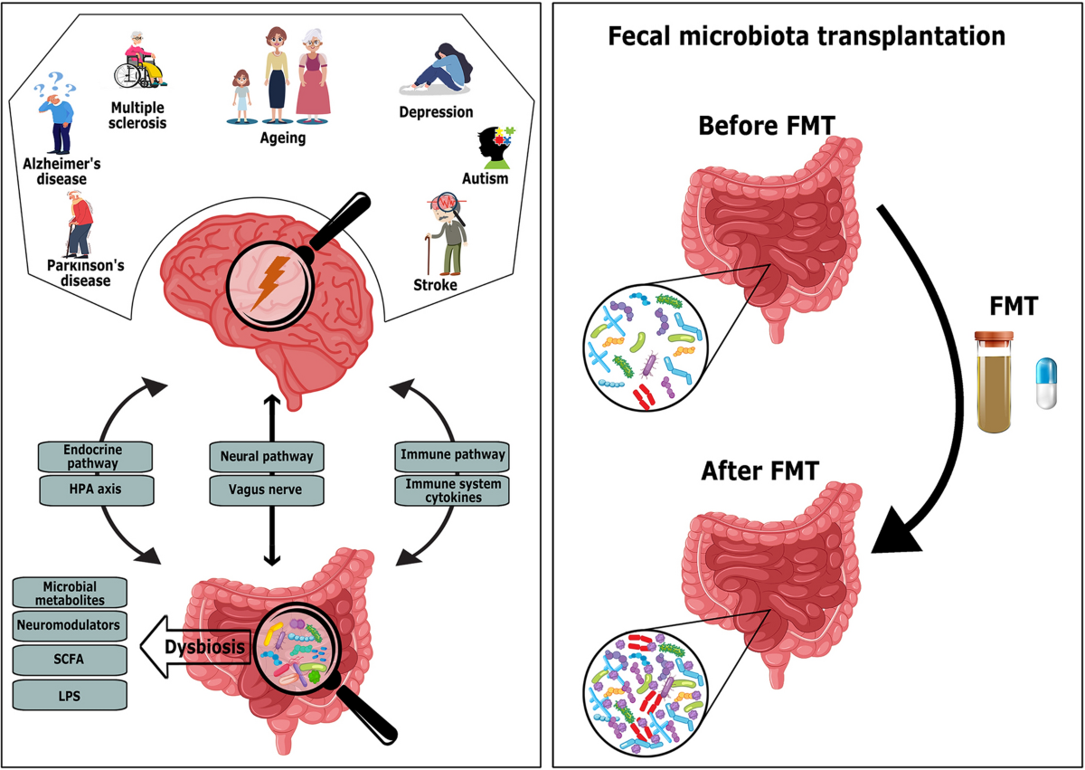 Dysbiosis and fecal microbiota transplant: Contemplating progress in  health, neurodegeneration and longevity | Biogerontology | Springer Nature  Link