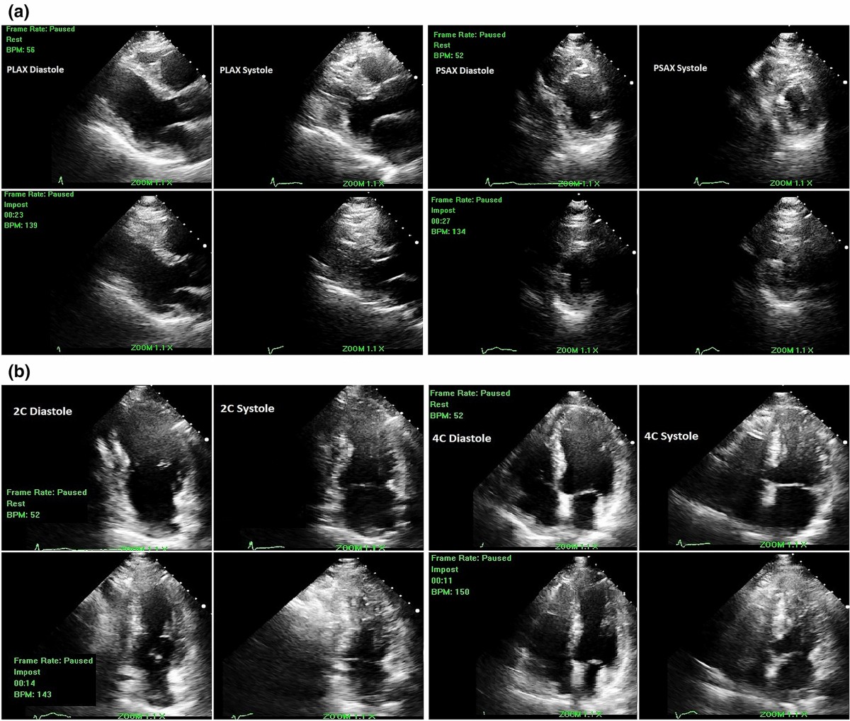 Long-term prognosis and predictors of outcomes after negative stress  echocardiography | The International Journal of Cardiovascular Imaging |  Springer Nature Link