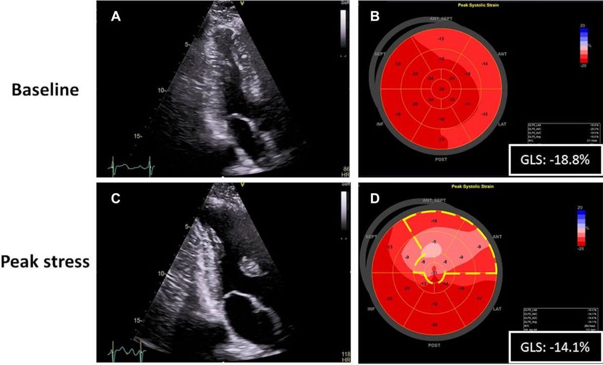 Accuracy of global and regional longitudinal strain at peak of dobutamine  stress echocardiography to detect significant coronary artery disease | The  International Journal of Cardiovascular Imaging