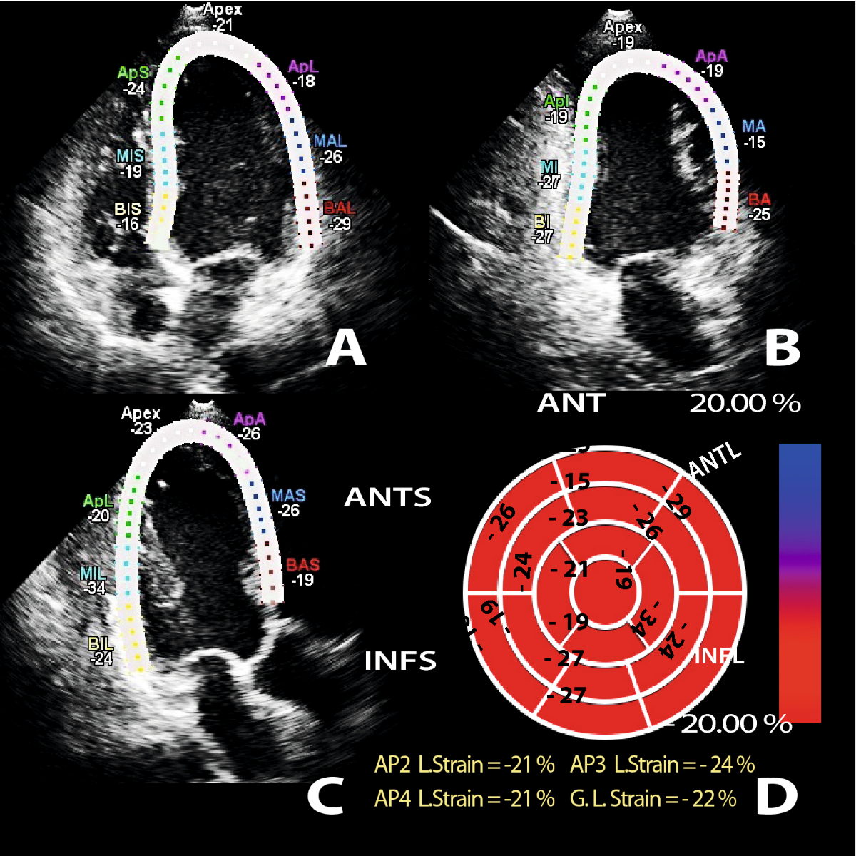 Left ventricular global longitudinal strain in low cardiac risk outpatients  who recently recovered from coronavirus disease 2019 | The International  Journal of Cardiovascular Imaging