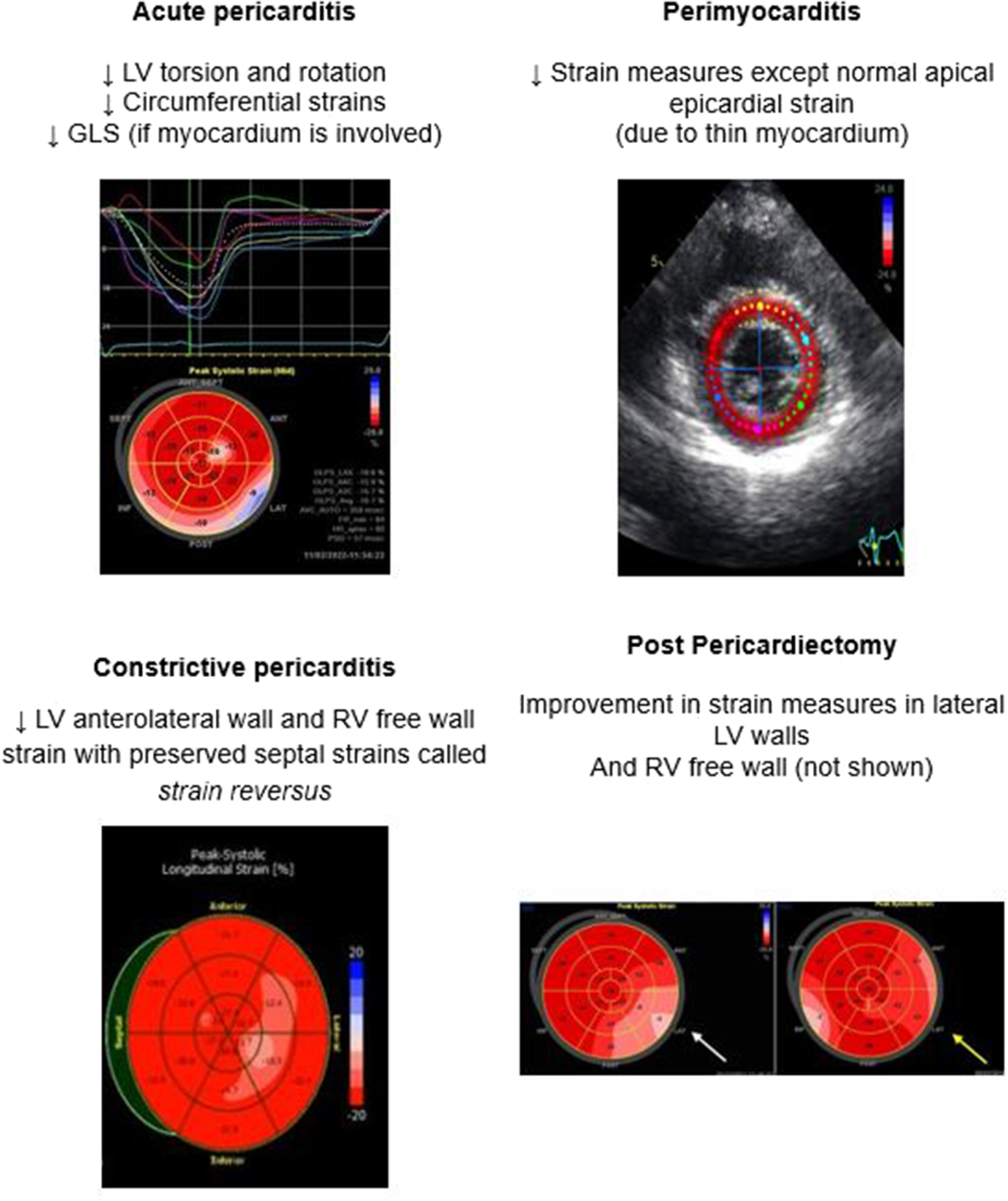 Role of strain imaging by echocardiography in pericardial diseases; a  scoping review | The International Journal of Cardiovascular Imaging