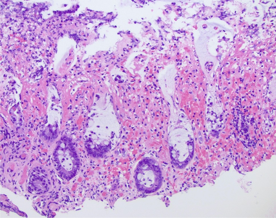 semaglutide gastric stasis legal team in dallas Ozempic Gastrointestinal Injury Lawsuit semaglutide gastric stasis legal team in dallas Ozempic Gastrointestinal Injury Lawsuit