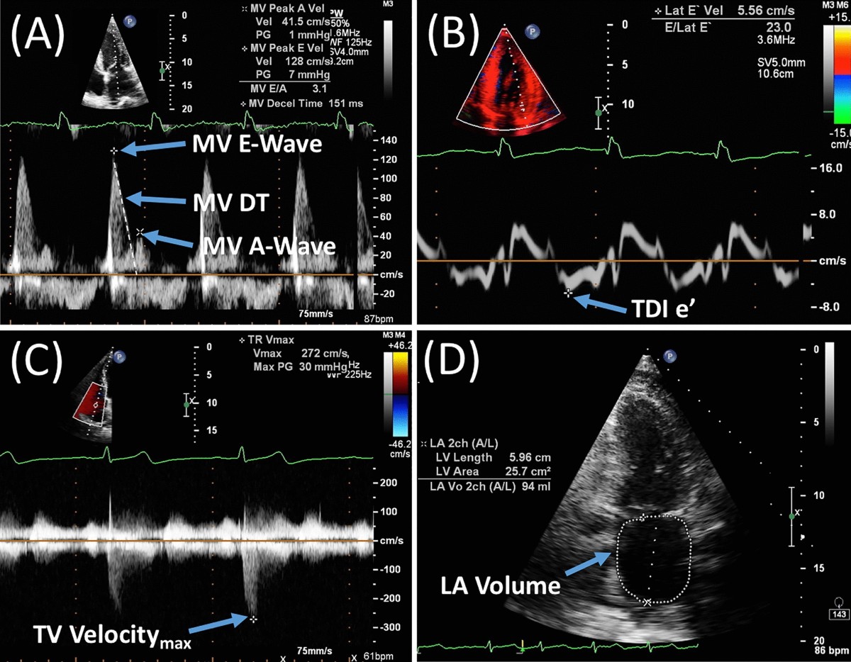HFpEF echocardiographic Doppler parameters: (A) mitral valve E-wave/A-wave ratio, (B) TDI e' velocity, (C) tricuspid valve velocity (TR Vmax for PASP), (D) enlarged LA volume - all used in HFA-PEFF scoring