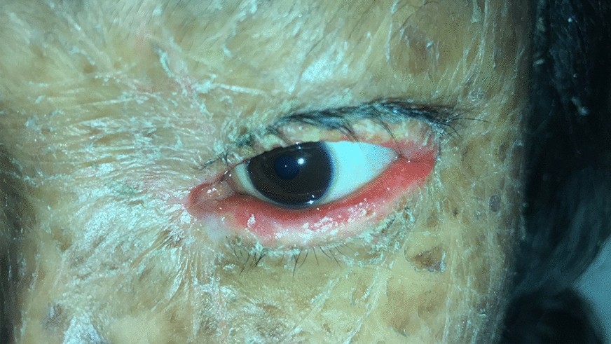 gross eye infection